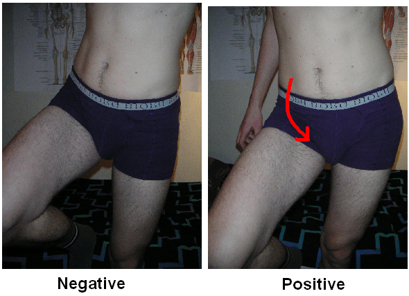 Two-panel photograph of single-leg stance: a level pelvis labelled negative and a dropped pelvis on the unsupported side labelled positive