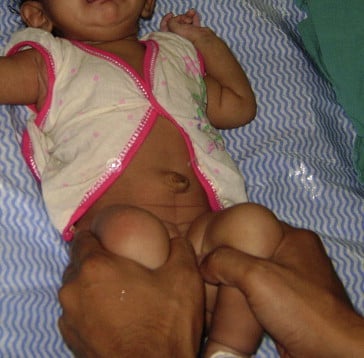 Barlow test technique for infant hip examination