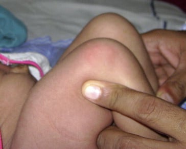 Galeazzi sign showing knee height comparison