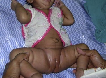 Ortolani test technique for infant hip examination