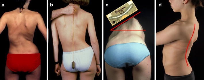 Clinical examination for scoliosis showing trunk asymmetry and rib hump assessment