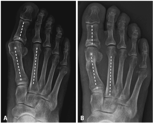 Clinical image for Hallux Valgus