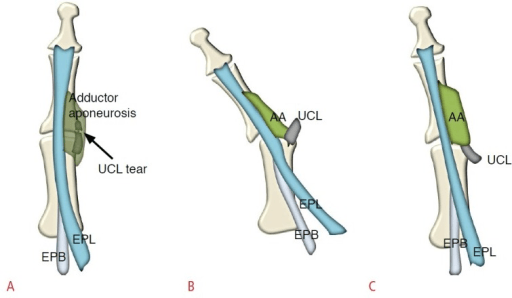 Clinical photograph showing stress testing of the thumb MCP joint for UCL injury - the examiner applies radial stress while palpating the ulnar border. Adjacent MRI shows a complete UCL tear with Stener lesion - the UCL (arrow) is displaced superficial to the adductor aponeurosis. Stener lesions require surgical repair as the ligament cannot heal in this position.