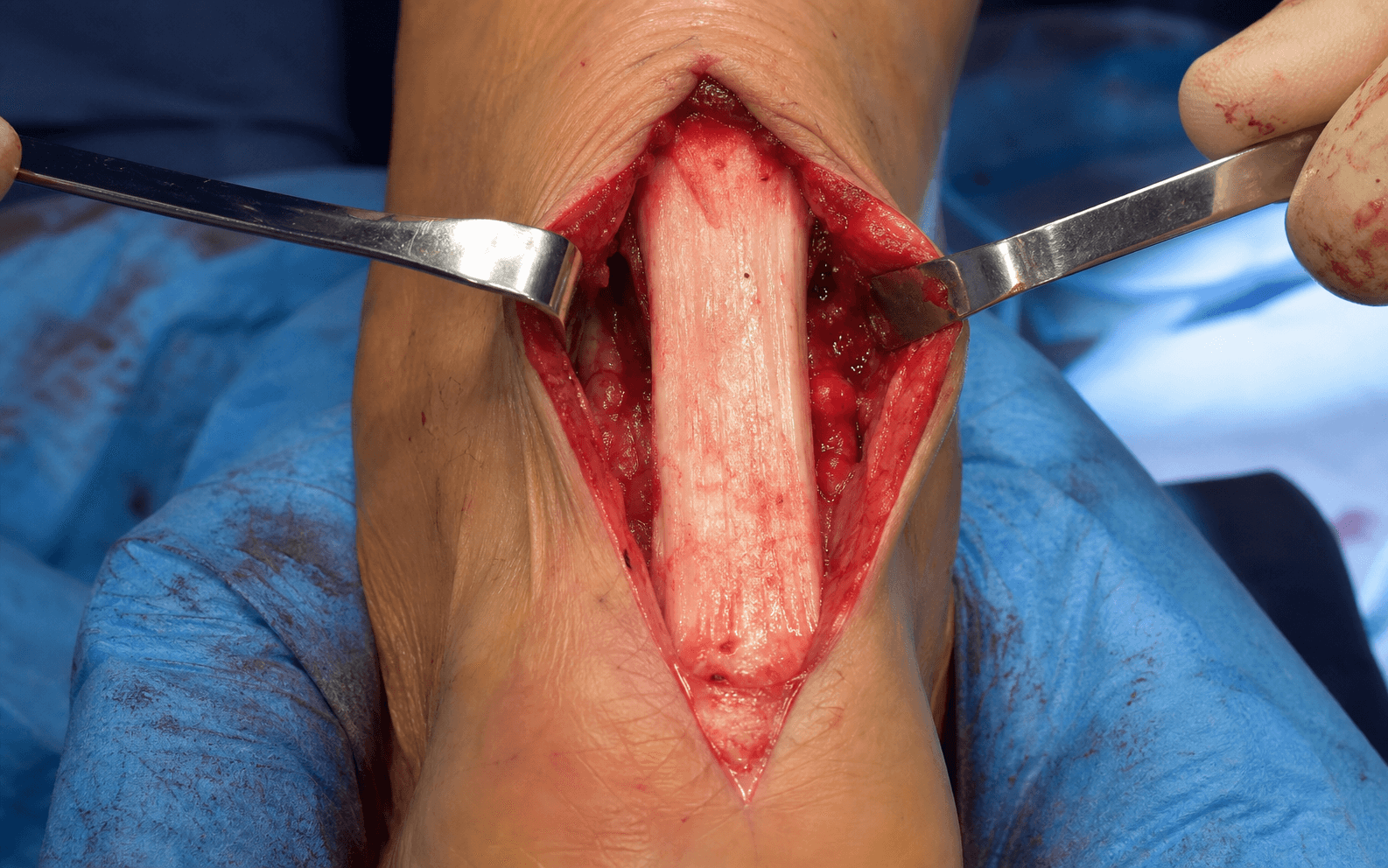 Posterior Achilles exposure