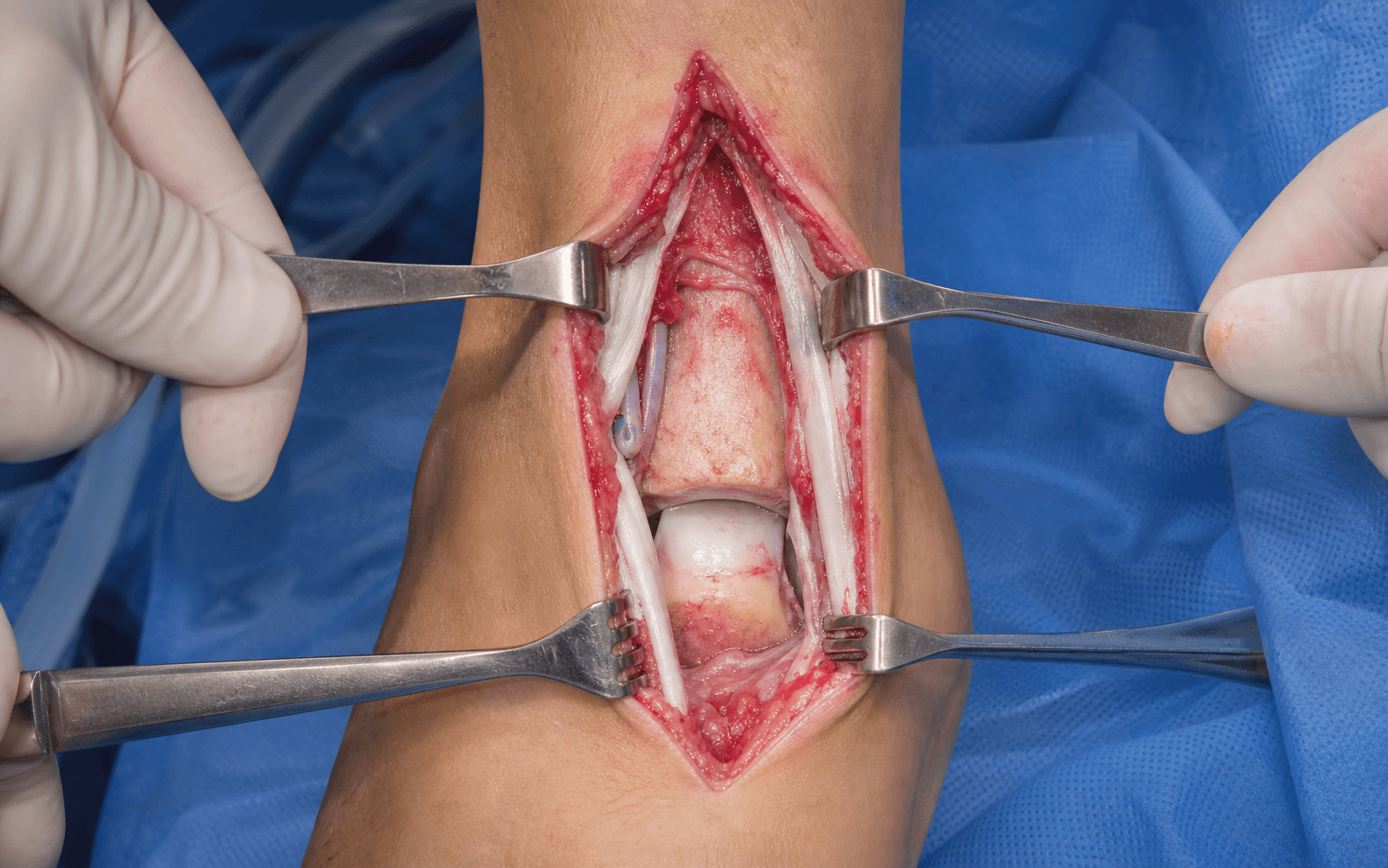 Anterior approach to the ankle