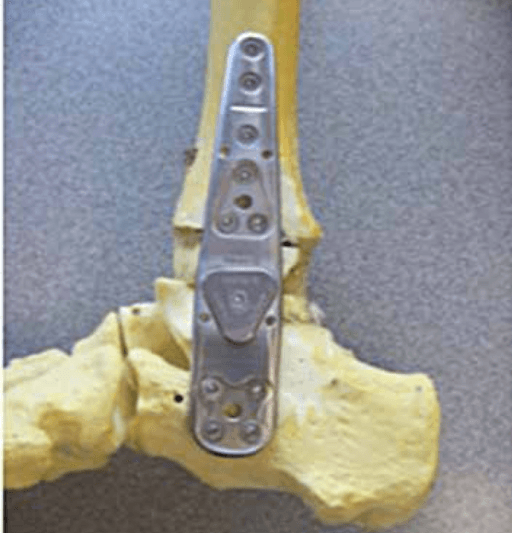 Lateral compression plate applied to bone model demonstrating tibiotalocalcaneal arthrodesis fixation