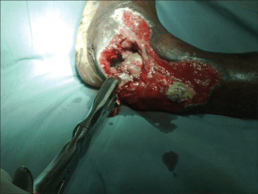 Intraoperative open ankle arthrodesis with drill inserted into exposed joint