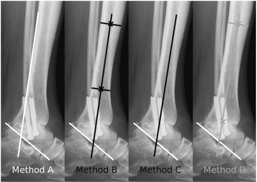 Four-panel radiograph comparison showing Methods A B C D for measuring tibiotalar alignment after ankle arthrodesis
