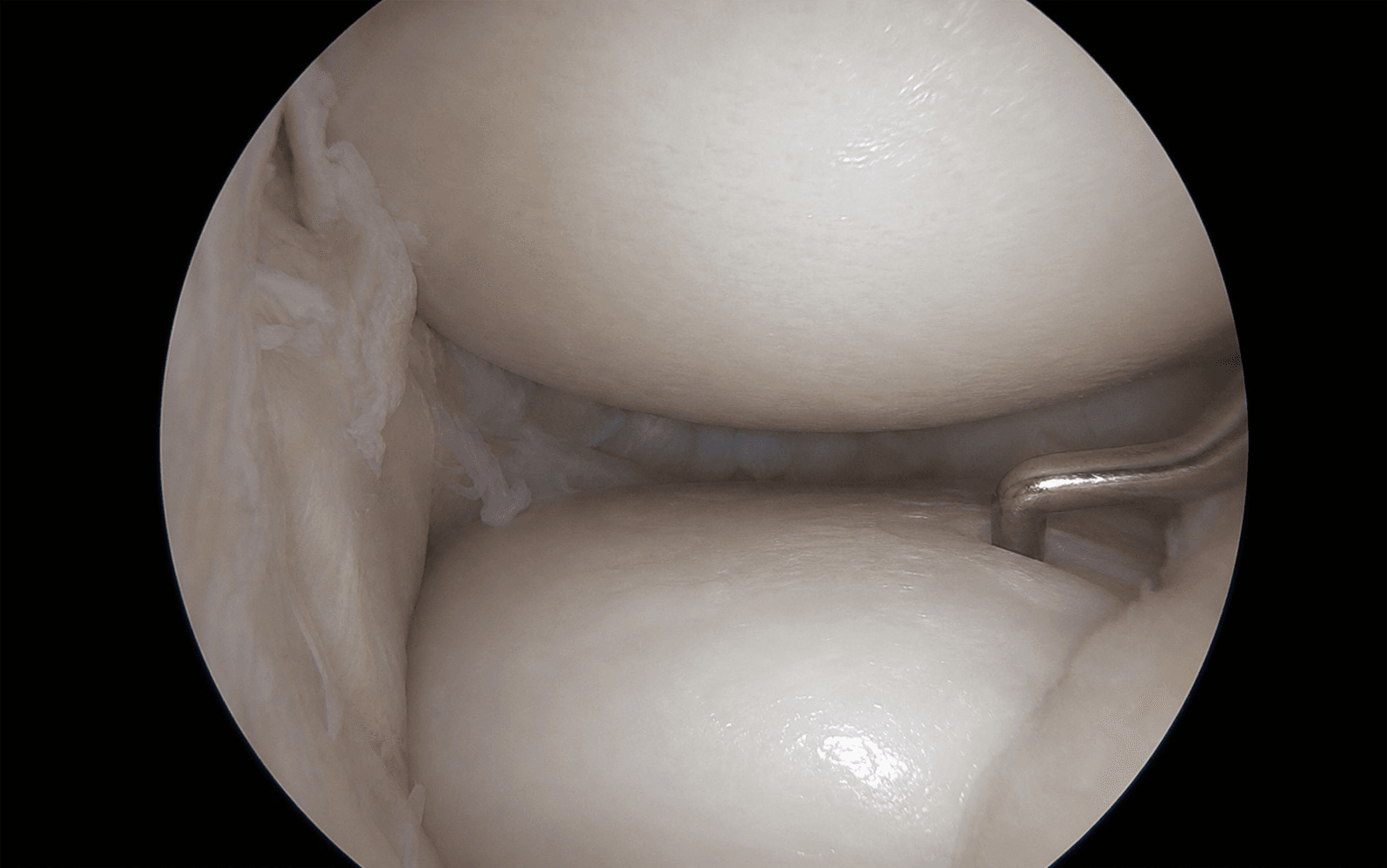 Ankle arthroscopy