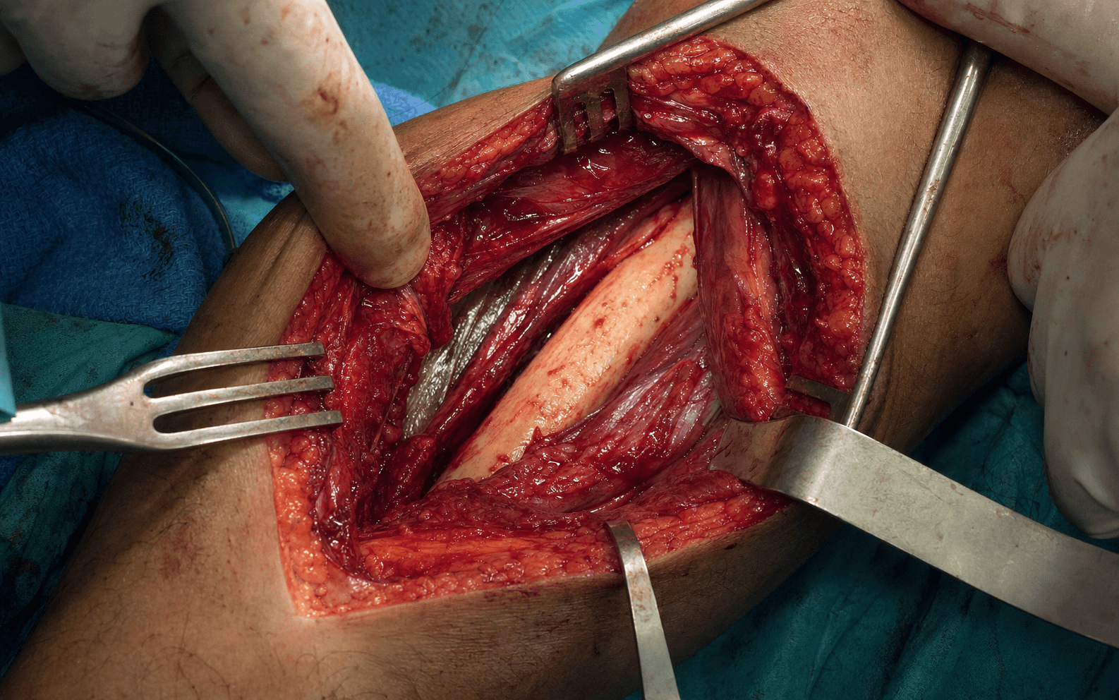 Anterior humeral shaft approach
