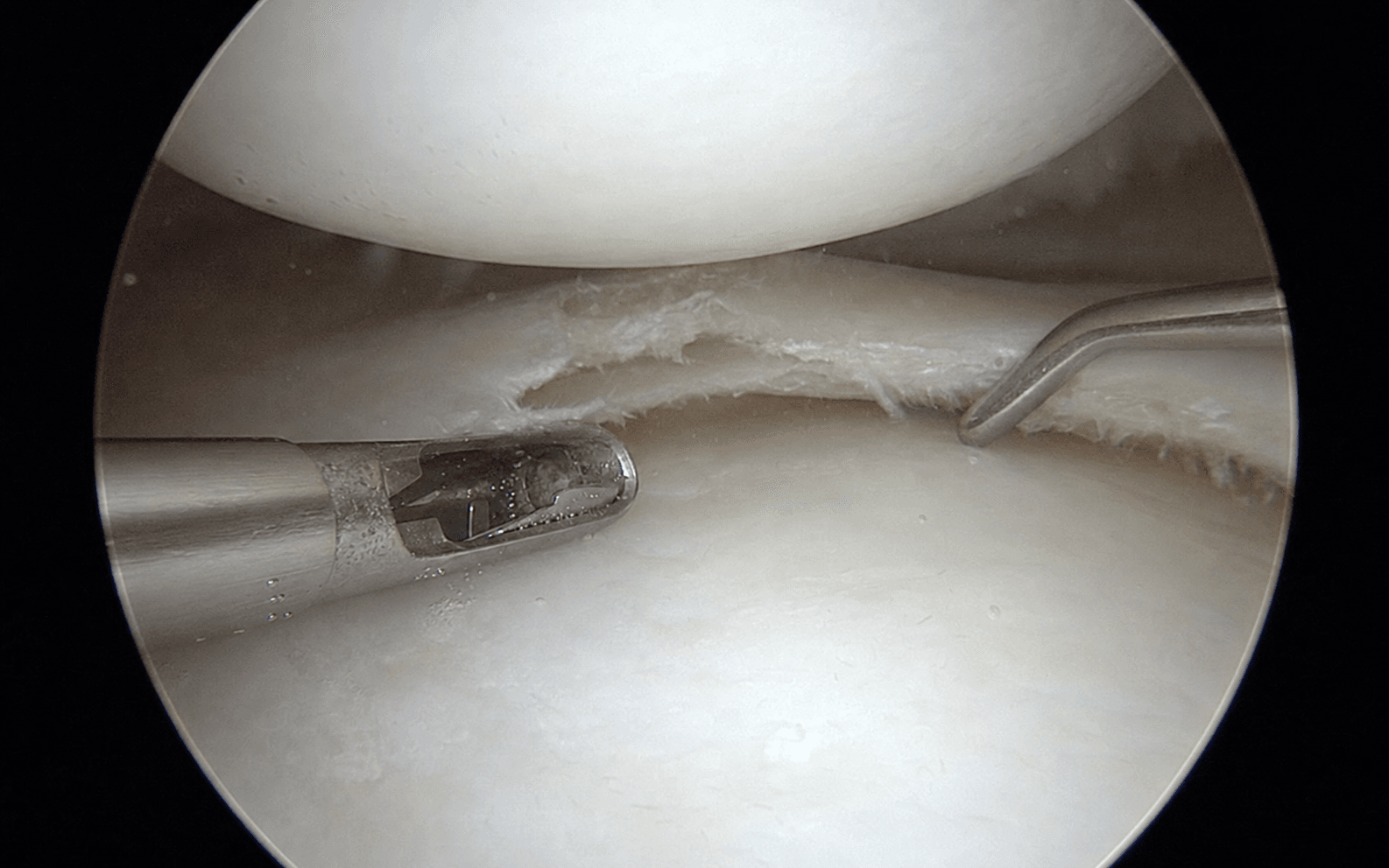 Arthroscopic partial meniscectomy