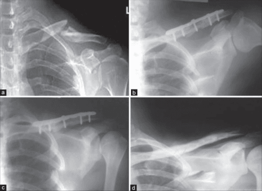 Four-panel X-ray series showing displaced midshaft clavicle fracture pre-op and post-op plate fixation with union