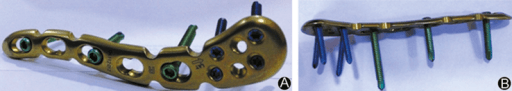 Distal clavicle locking plate shown from superior and lateral views with locking screws