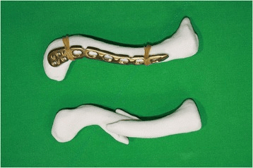 3D-printed clavicle bone model with plate applied showing pre-operative planning for minimally invasive plating