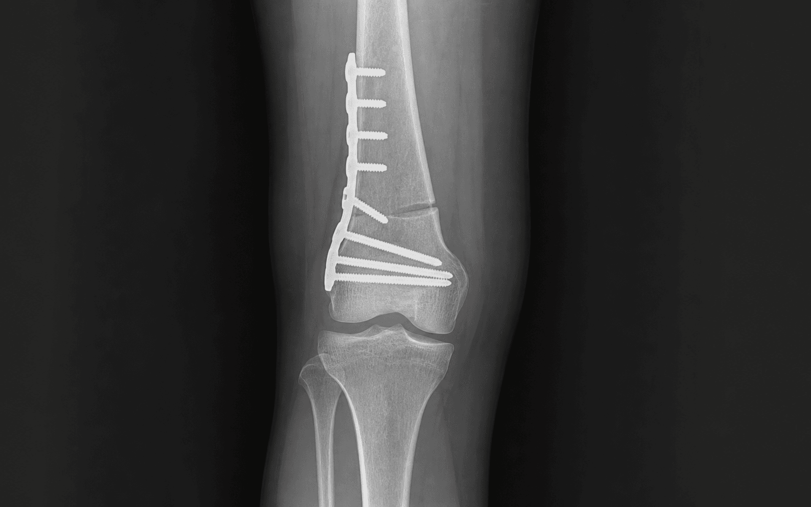 AP knee radiograph after a distal femoral osteotomy
