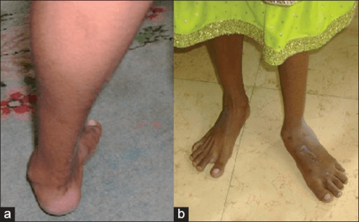 Two-panel clinical photos showing pes cavovarus deformity with equinovarus foot posture and bilateral comparison