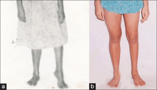 Two-panel pre and post-operative clinical comparison of leg alignment in cavovarus deformity