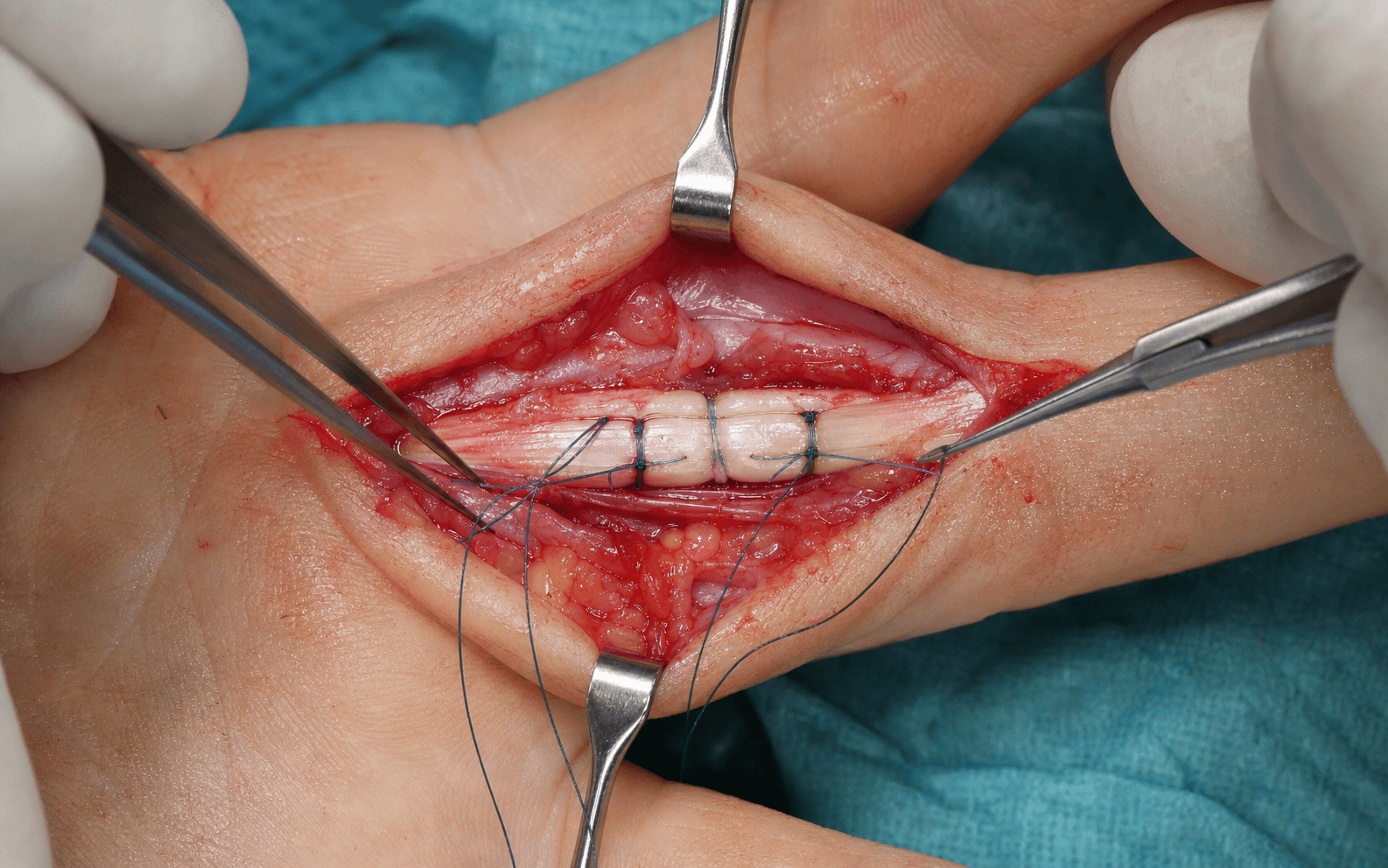 Zone 2 flexor tendon repair