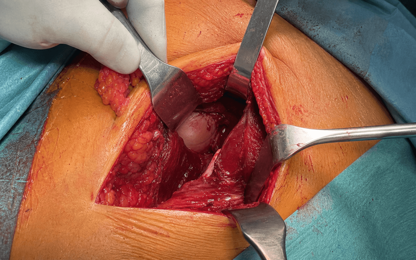 Medial (Ludloff) hip approach