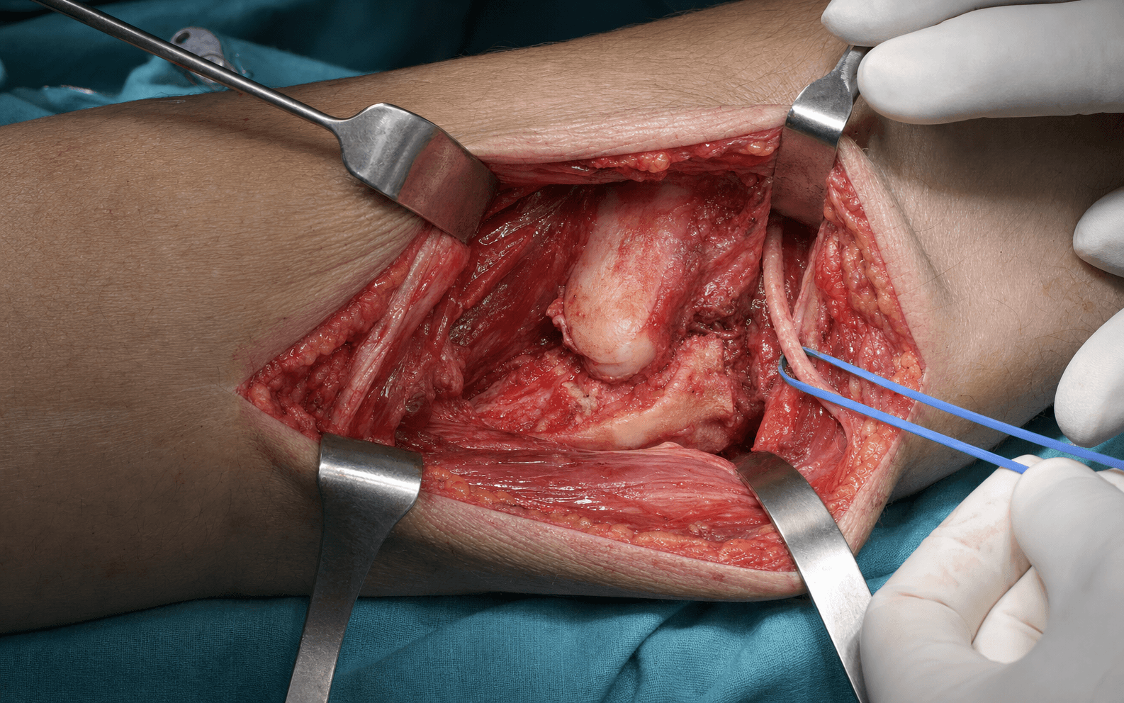 Hotchkiss medial elbow approach