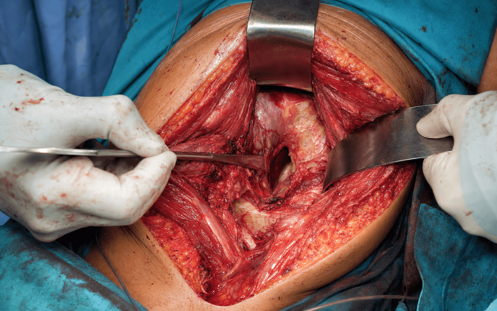 Ilioinguinal acetabular approach