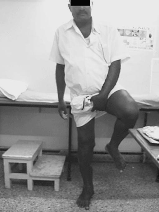 Patient seated demonstrating functional outcome of knee arthrodesis with a straight fused leg