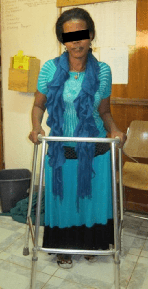 Patient ambulating with walking frame after knee arthrodesis using SIGN nail — straight fused leg