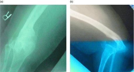 AP and lateral X-rays of knee showing pathology requiring arthrodesis