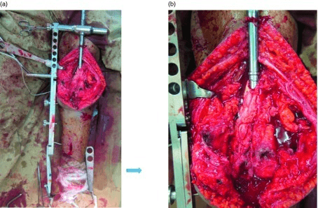 Intraoperative two-panel showing SIGN nail insertion for knee arthrodesis