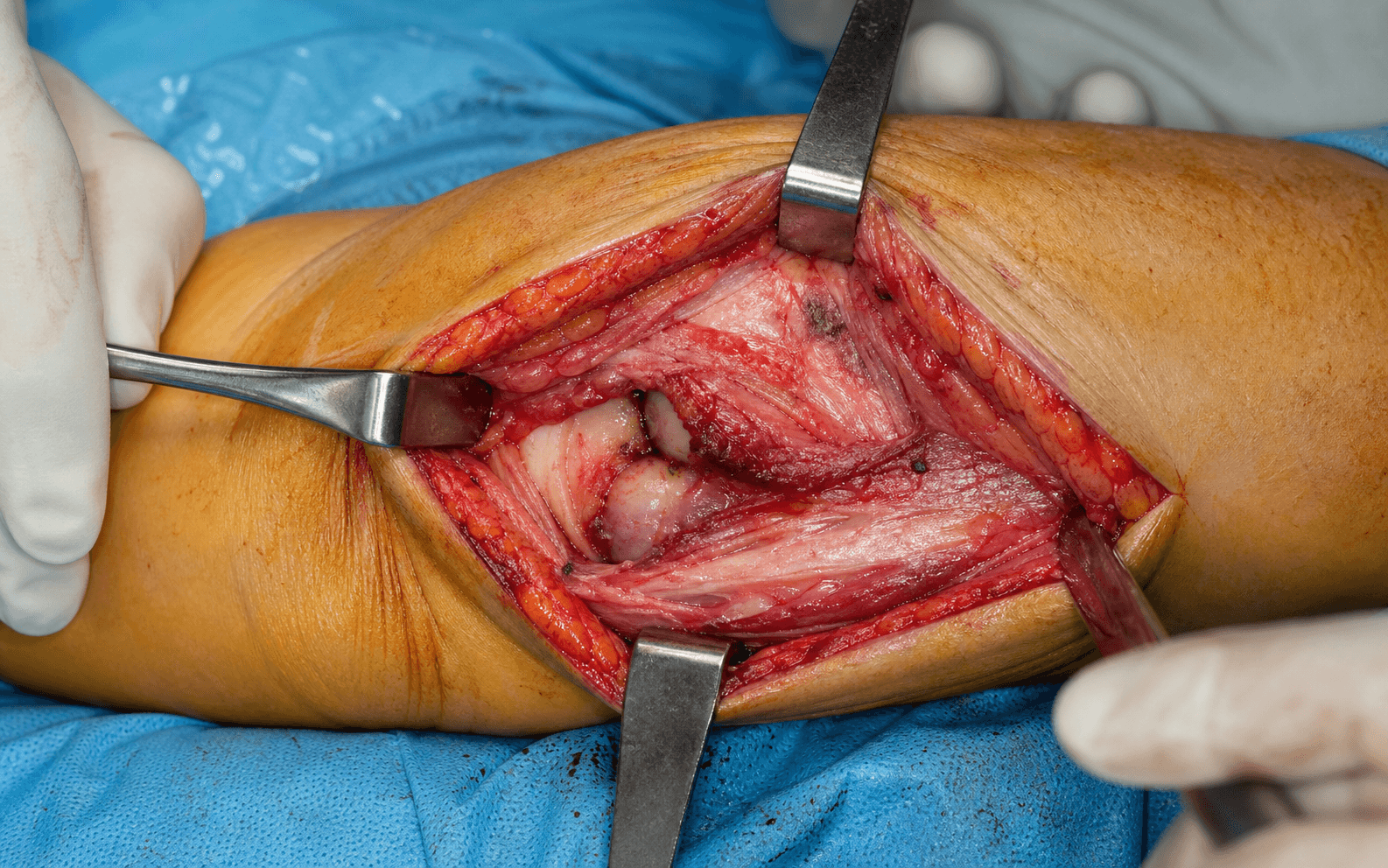 Kocher approach to elbow