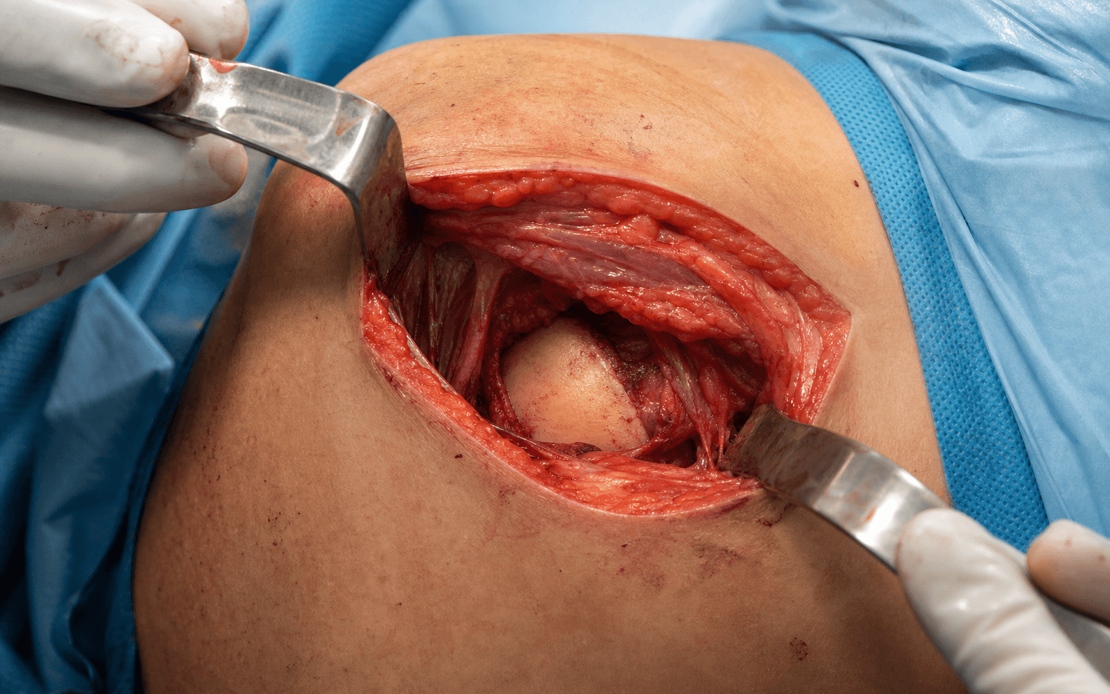 Lateral proximal humerus approach