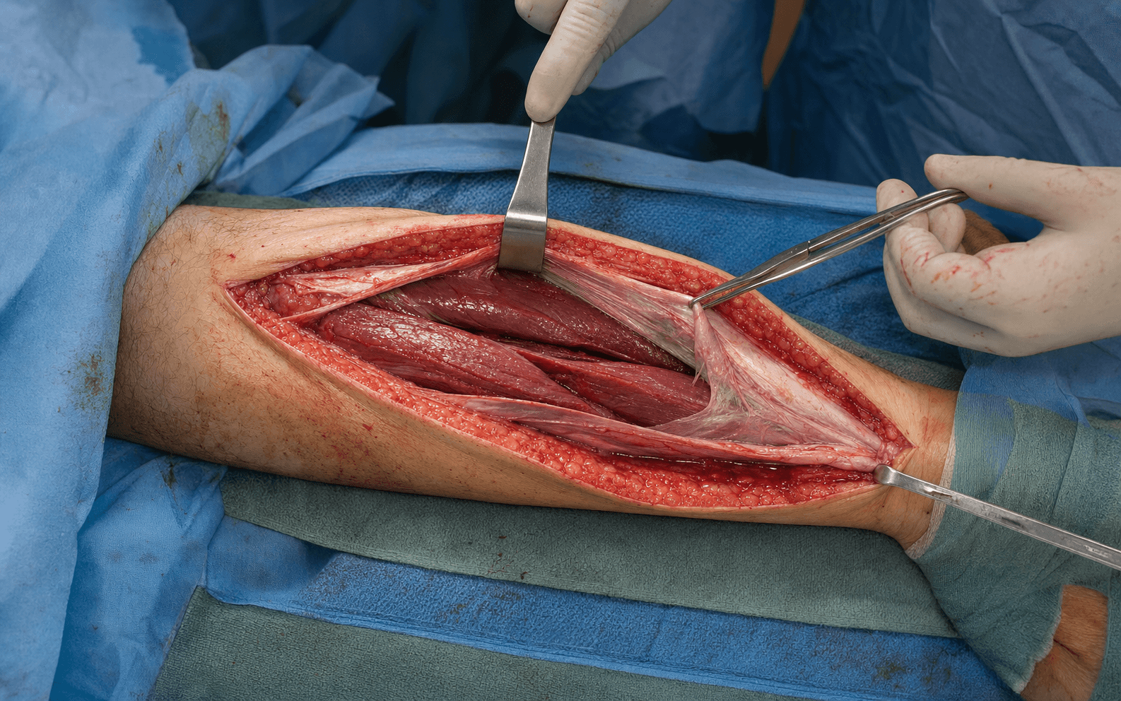 Leg fasciotomy