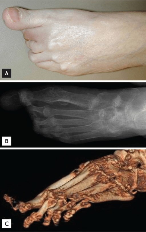 Three-panel showing clinical claw toes AP foot X-ray with dislocated MTP joints and 3D CT reconstruction