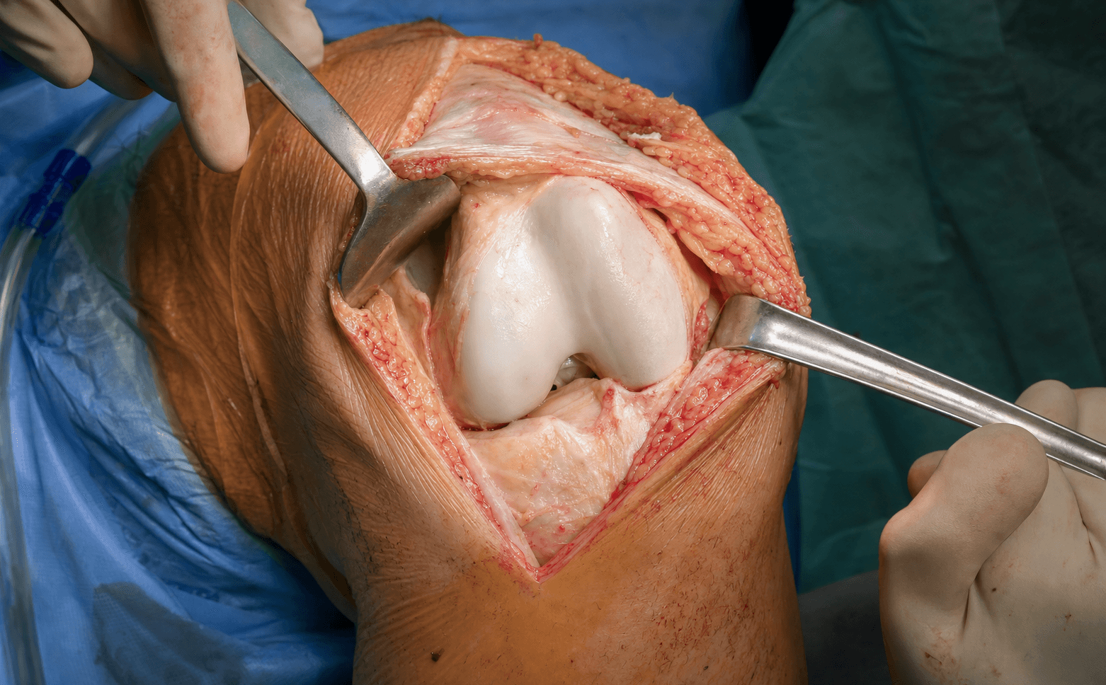 Medial parapatellar arthrotomy
