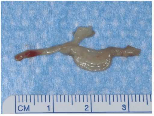 Excised Morton's neuroma specimen on ruler showing approximately 2.5 cm length with fusiform swelling