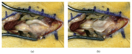 Two-panel intraoperative dorsal incision showing neuroma exposure with wound edges retracted