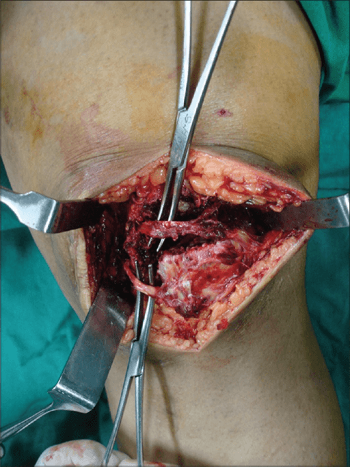 Intraoperative open view of graft fixation at the medial patellar border during MPFL reconstruction