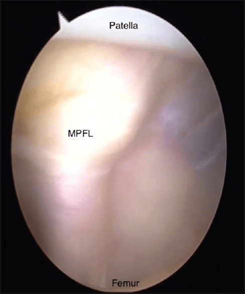 Arthroscopic view of the medial knee with the patella, MPFL and medial femoral condyle labelled