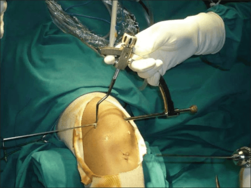 Intraoperative photo of graft passage and femoral-side fixation at the medial femoral epicondyle