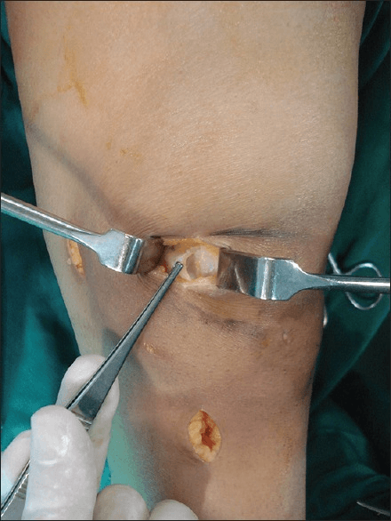 Intraoperative photo showing two small medial incisions used for minimally invasive MPFL reconstruction