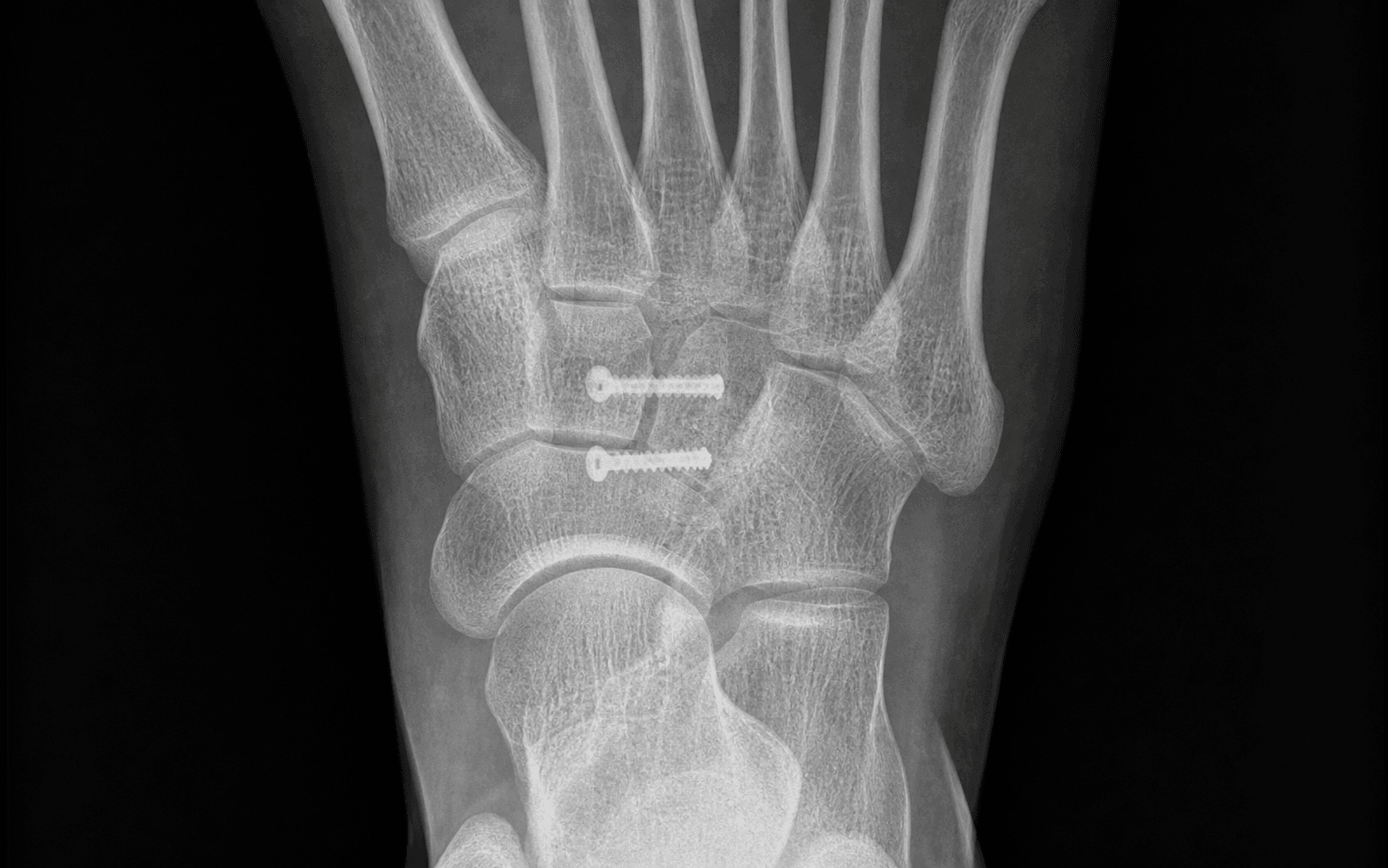 Tarsal navicular fracture screw fixation