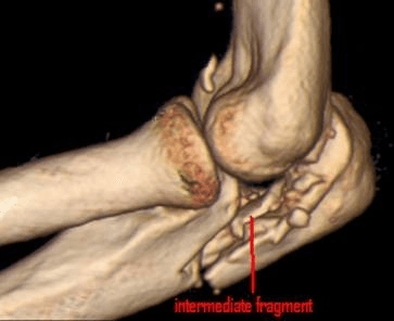 3D CT reconstruction of olecranon fracture showing intermediate comminuted fragment