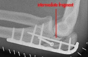 Post-operative lateral elbow X-ray showing posterior plate fixation of olecranon fracture