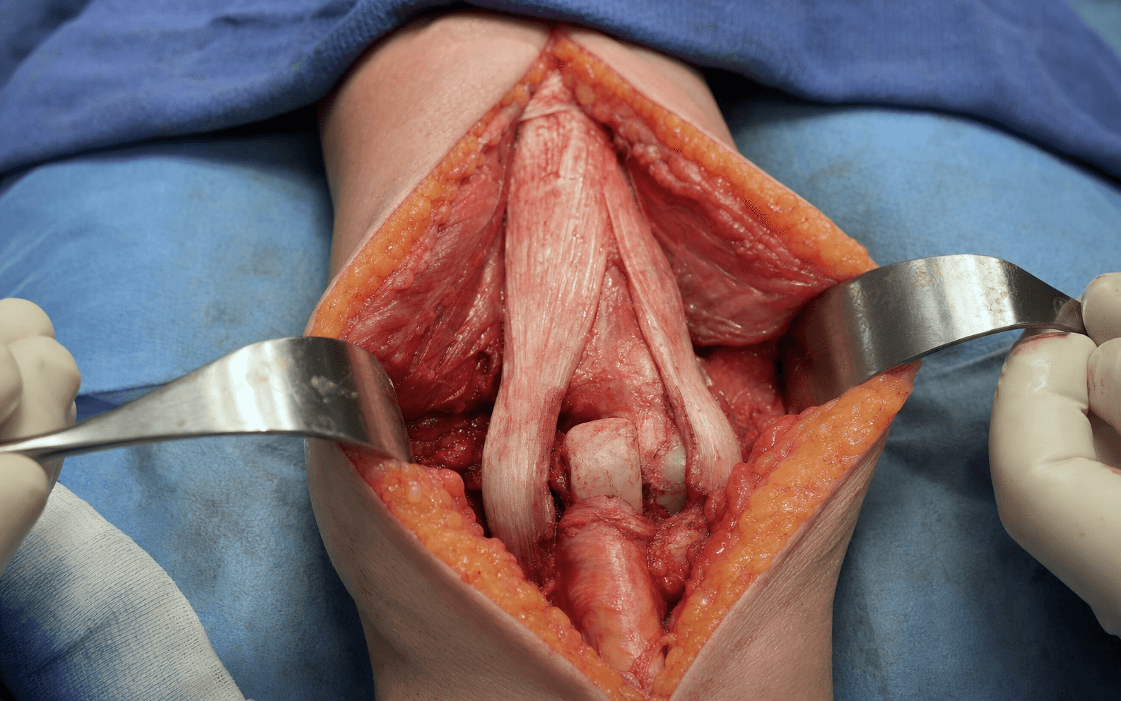 Posterior elbow approach