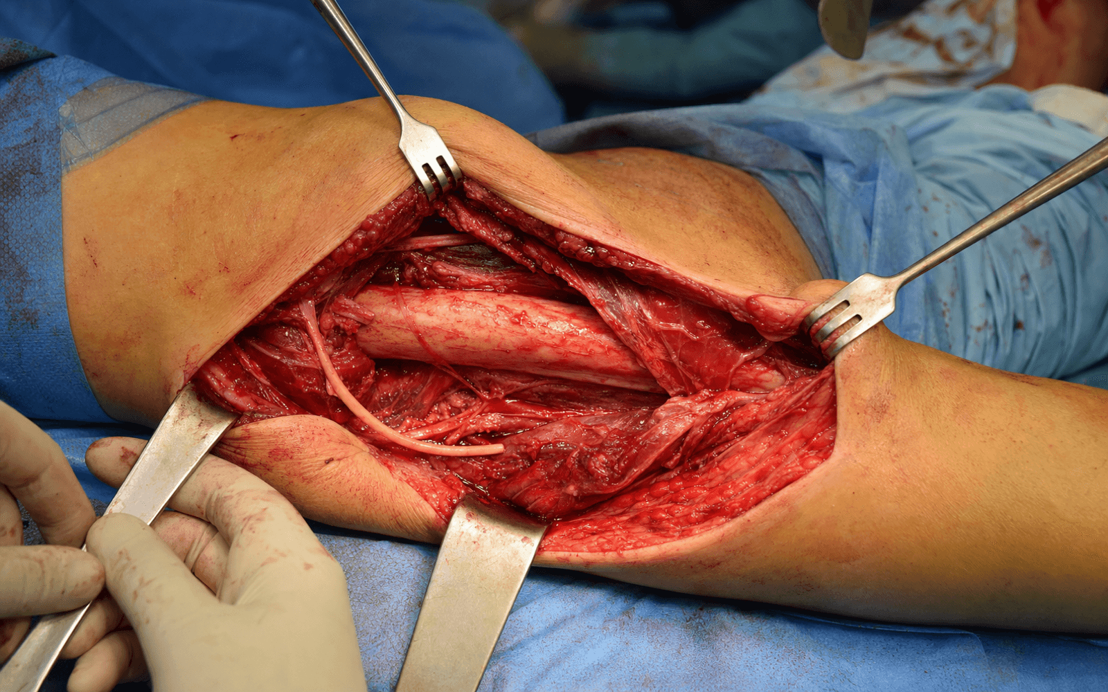 Posterior humerus approach