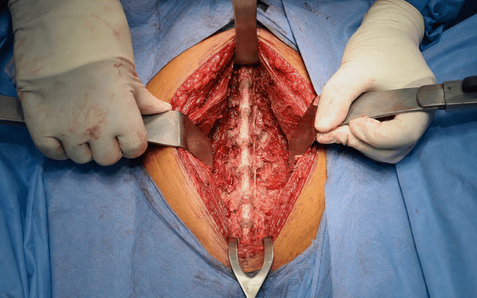 Posterior lumbar approach