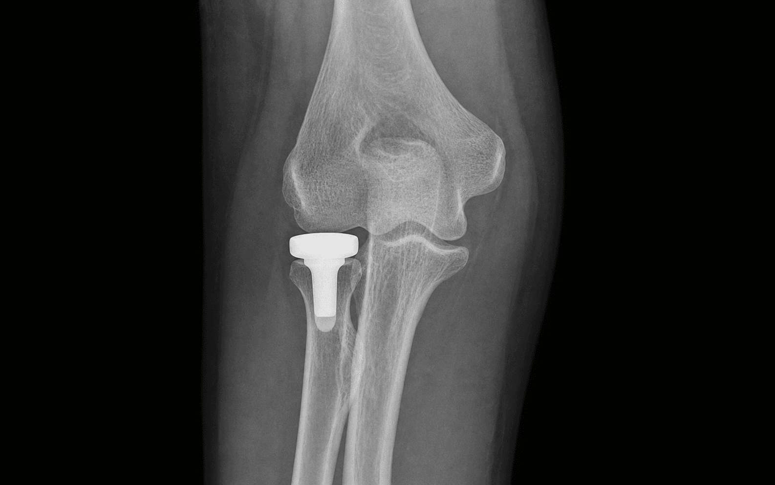 Radial head arthroplasty