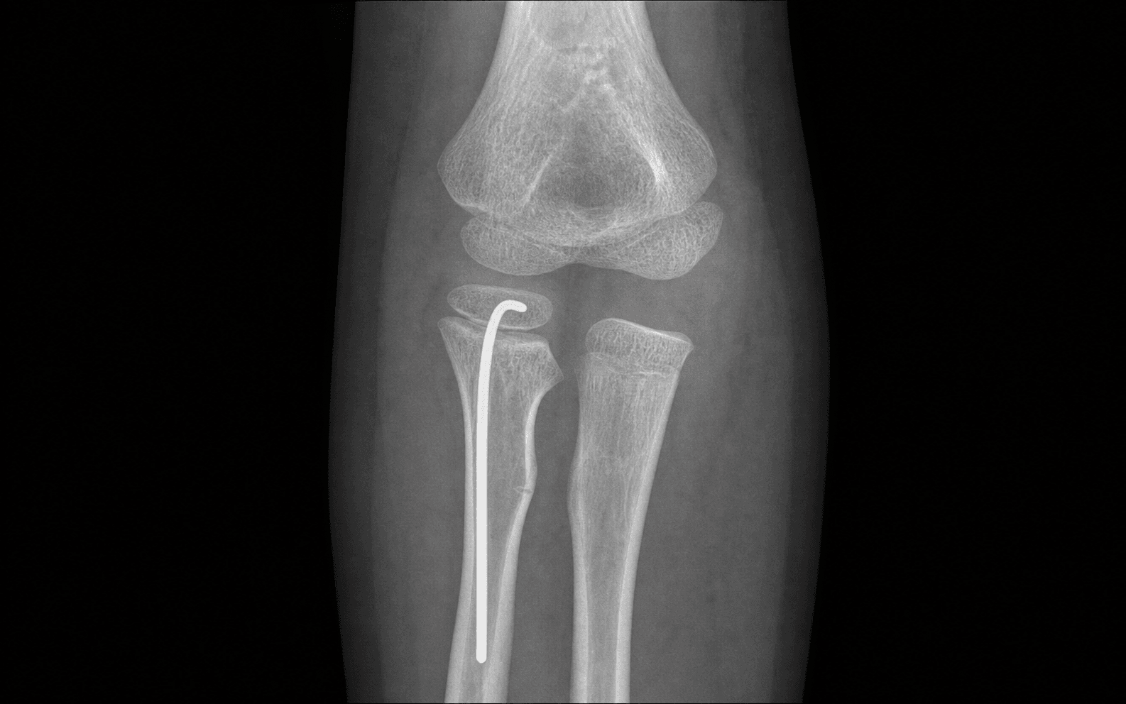 Paediatric radial neck fracture elastic nailing