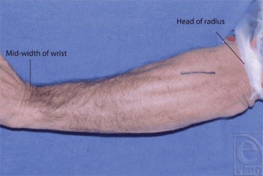 Clinical photograph of forearm with blue line marking radial tunnel incision from radial head to mid-wrist