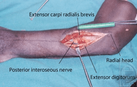 Intraoperative image with labels showing posterior interosseous nerve between ECRB and extensor digitorum with radial head visible